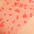 Can skin care products cause hives?