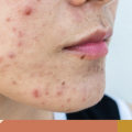Can skin care products cause cystic acne?