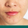 Will skincare break me out?