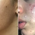 Can skin care products cause acne?