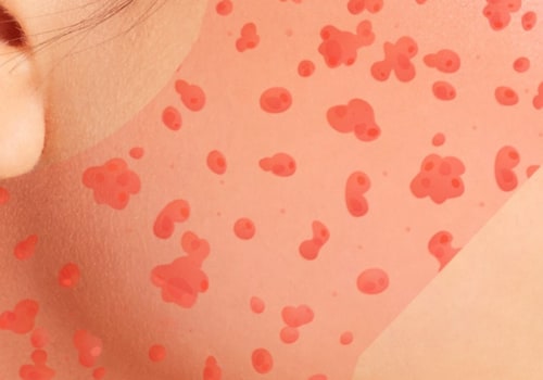 Can you get hives from skincare products?