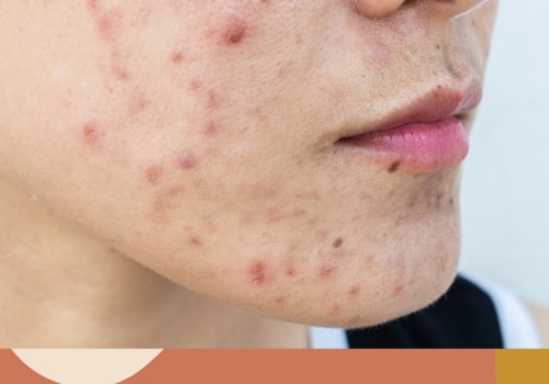 Can skin care products cause cystic acne?