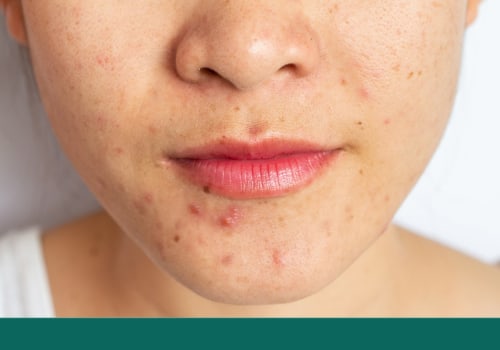 Will skincare break me out?