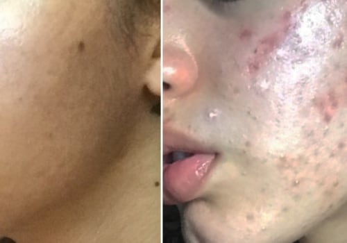 Can skin care products cause acne?
